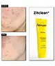 Acnemy - Zitless® Microdart Patches & Zitclean® Mini Cleansing Gel Duo